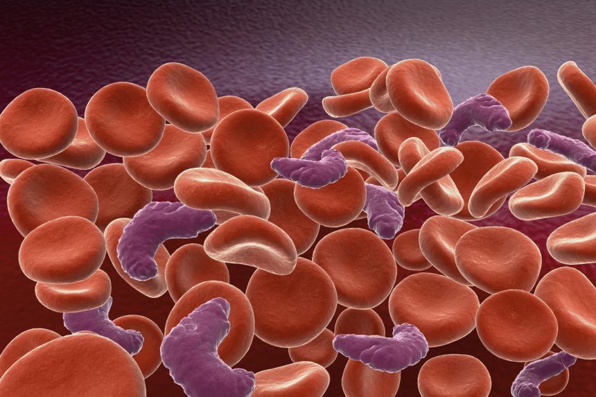 Sickle Cell Anemia Treatment - Dr. Vikas Dua - Sickle Cell Anemia Doctor in Delhi