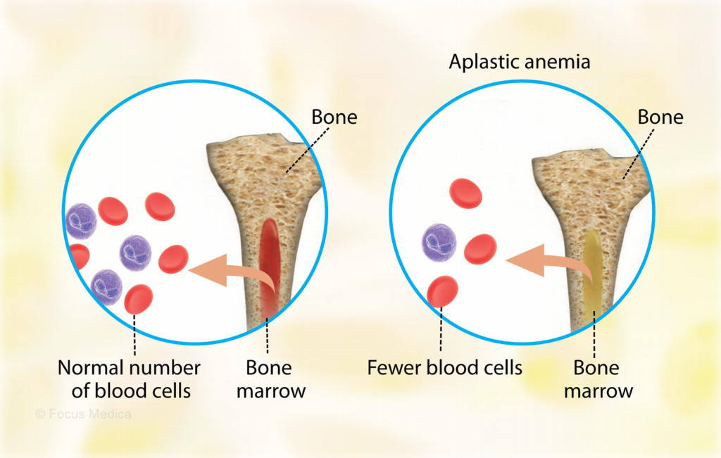 aplastic-anemia-in-children-best-aplastic-anemia-doctors-in-india