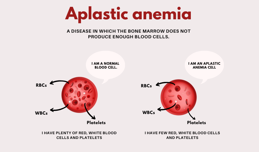 Aplastic Anemia Treatment in Delhi: A Comprehensive Guide