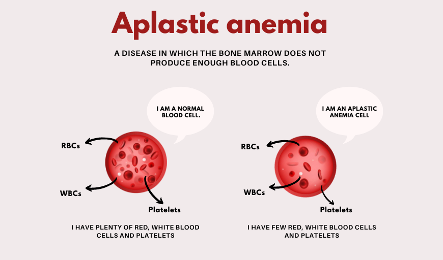 Aplastic Anemia Treatment in Delhi - Dr Vikas Dua