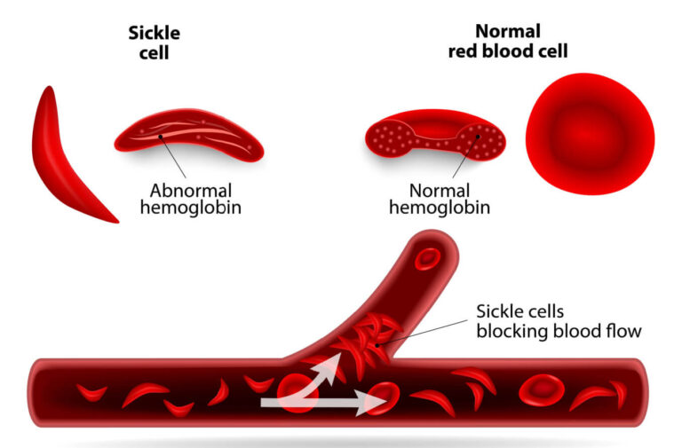 Sickle Cell Anemia Treatment in Delhi - Dr Vikas Dua