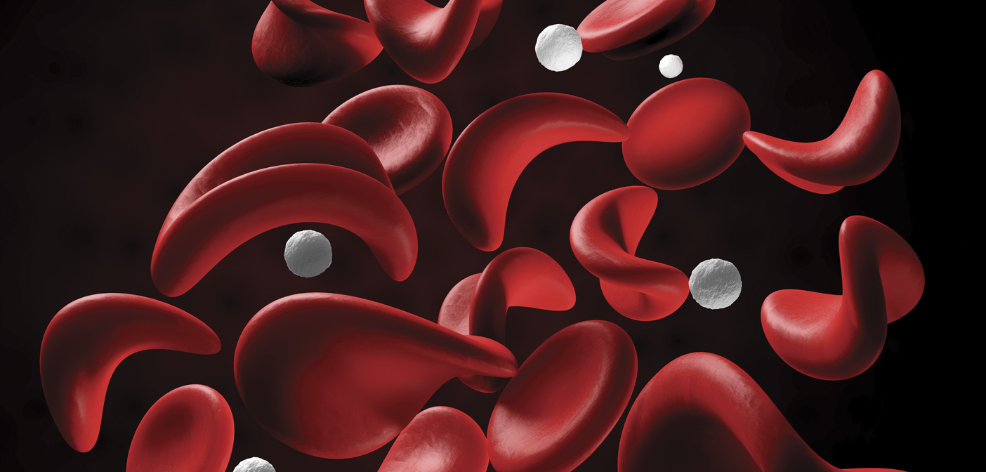 Understanding Sickle Cell Anemia: Causes, Symptoms, and Diagnosis