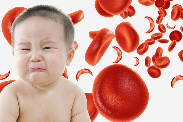 Sickle Cell Anemia: Understanding the Condition and Treatment Options