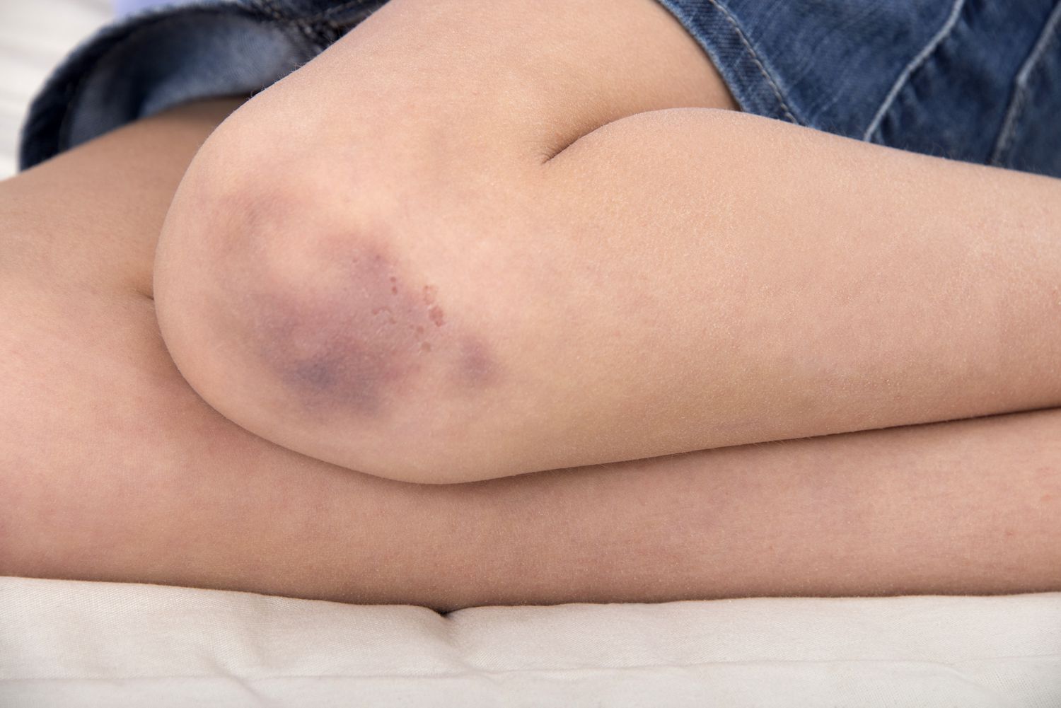 Unexplained Bruising in Children - A Warning Sign
